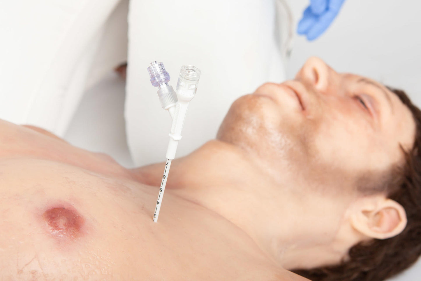 Russell PneumoFix®-8 Sterile Decompression Needle - Prometheus