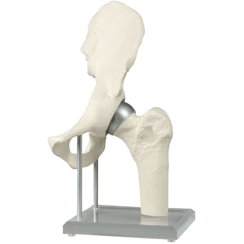 Hip Joint Model with Resurfacing Implant