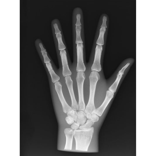 X-Ray Phantom Hand - Opaque - Erler Zimmer