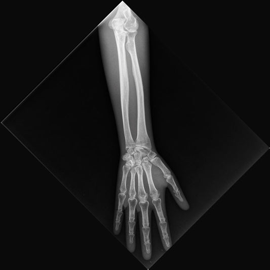 X-Ray Phantom Lower Arm - Opaque - Erler Zimmer