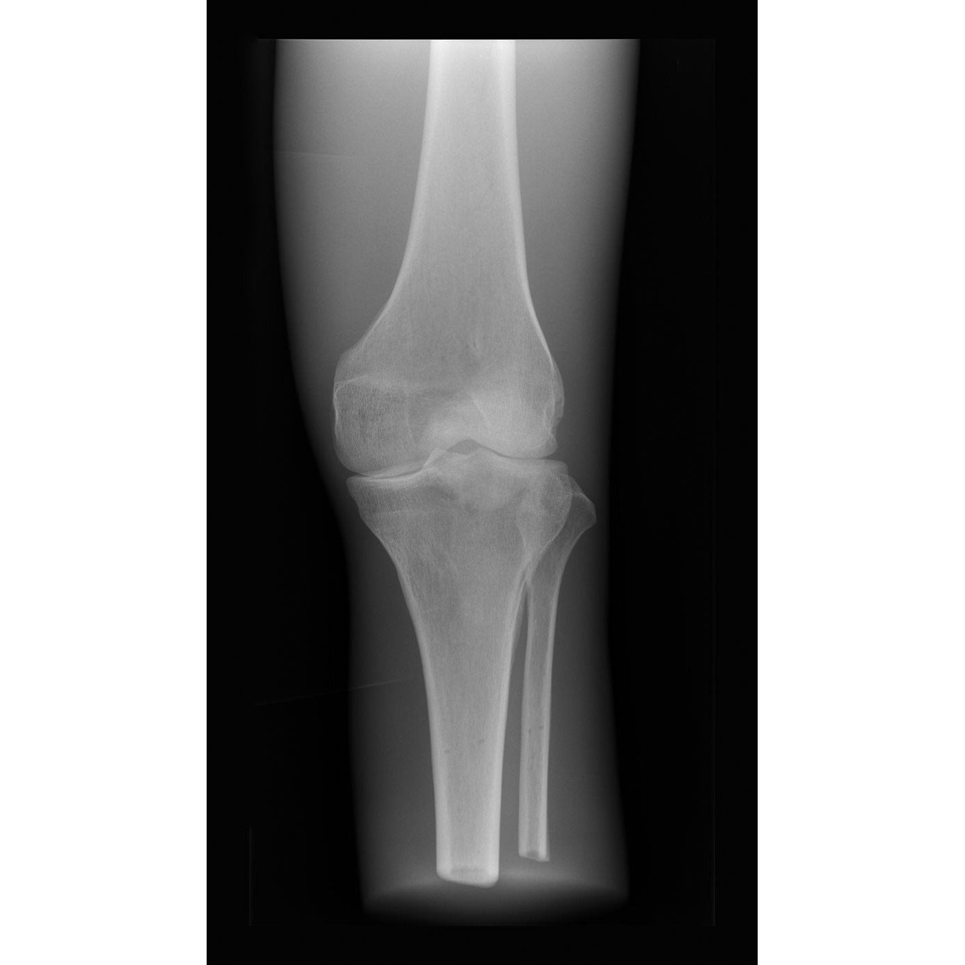 X-Ray Phantom Knee - Opaque - Erler Zimmer