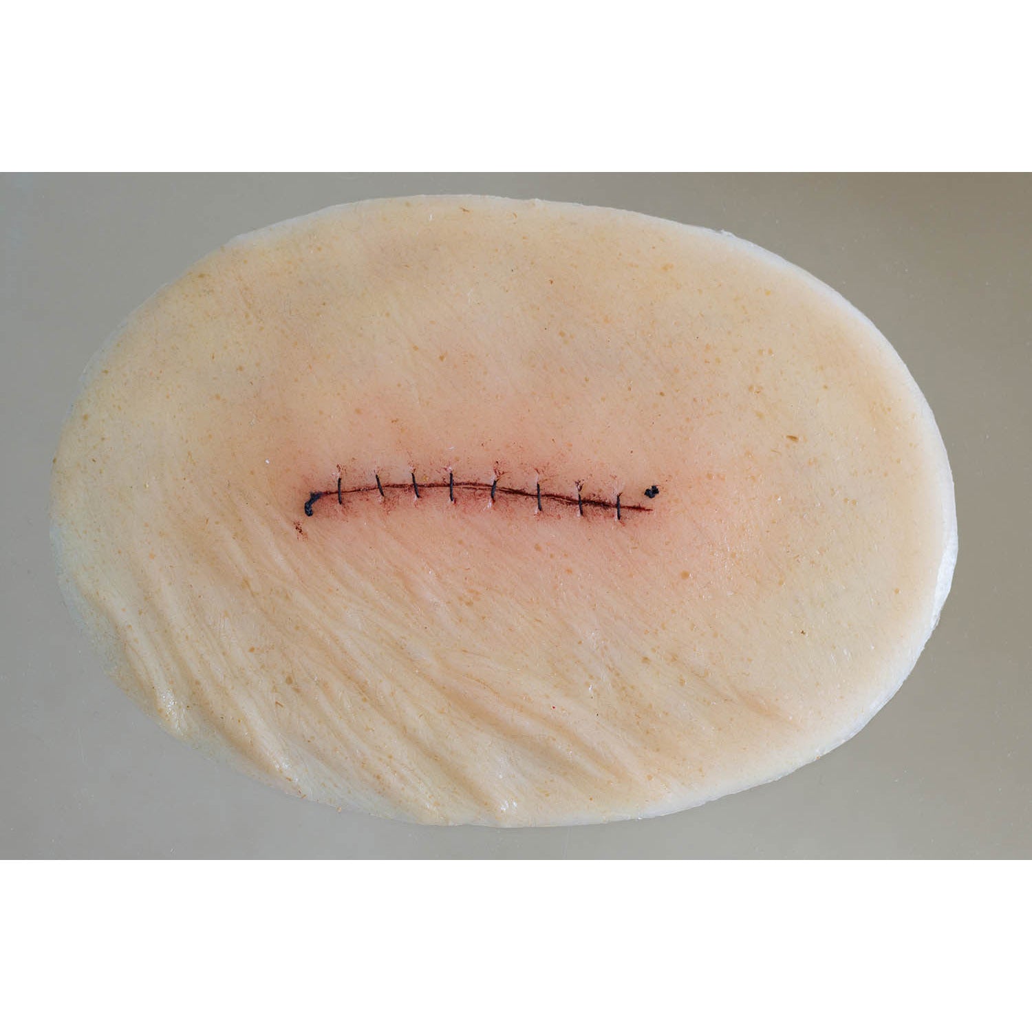 Surgical Wound - Sutured - slightly Inflamed - Large - Erler Zimmer