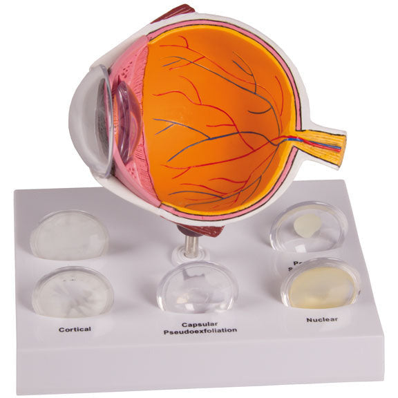 Cataract Eye Model - Erler Zimmer