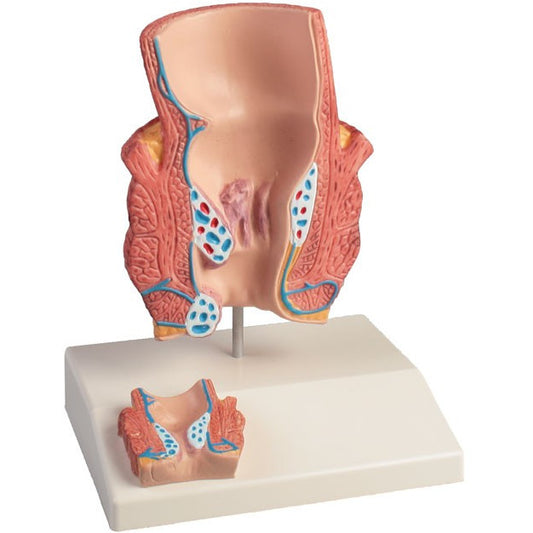 Haemorrhoids Model - Twice Life-Size