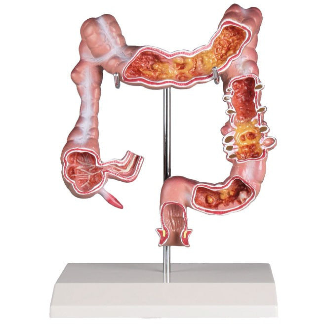 Colon Model with Diseases