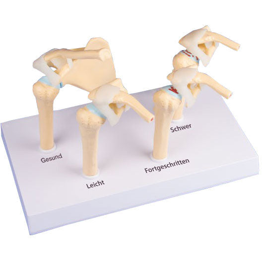 4-Stage Osteoarthritis Model - Shoulder